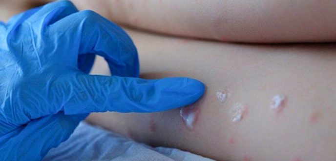 الصحة تصدر دليلا حول كيفية العدوى بمرض “جدري القرود” وسبل الوقاية منه