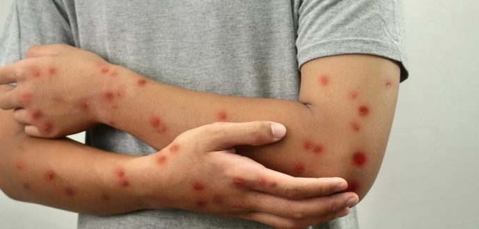 شبكة صحية تنتقد الفشل في التصدي لـ”بوحمرون” وتدعو لإعلان حالة طوارئ صحية