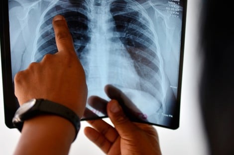 تسجيل 53 في المائة من حالات السل بالمغرب خلال 2025